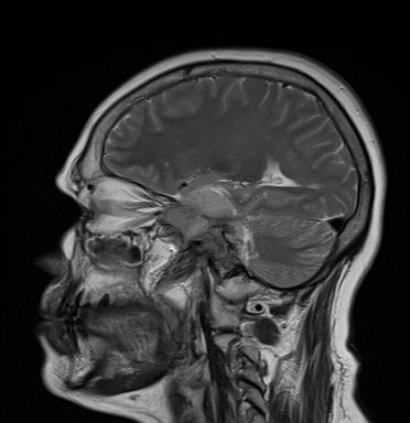 File:Cavernous sinus meningioma (Radiopaedia 63682-72367 Sagittal T2 7).jpg