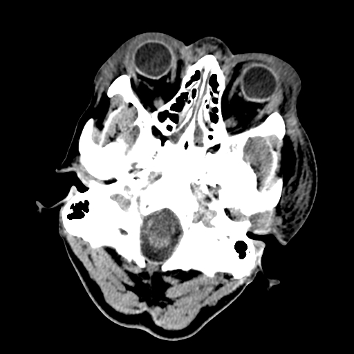 File:Cavernous sinus thrombosis (Radiopaedia 10619-11078 Axial non-contrast 4).jpg