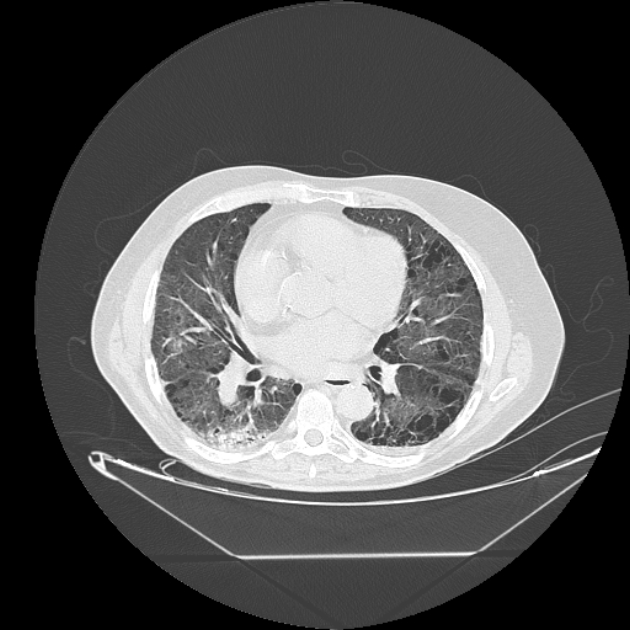 Cavitating bronchogenic carcinoma (Radiopaedia 44489-48162 Axial lung window 49).jpg