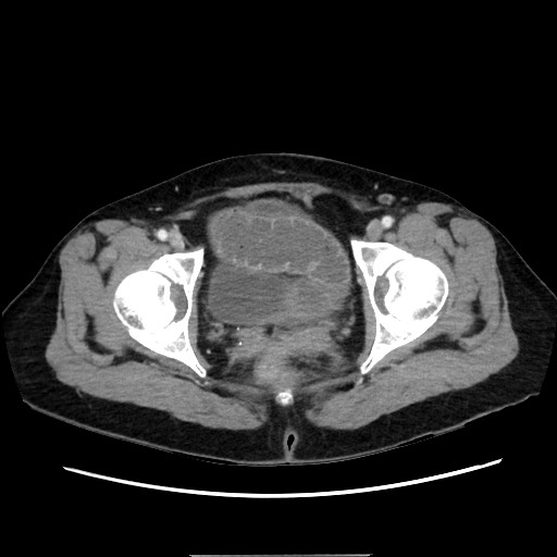 Cecal adenocarcinoma (Radiopaedia 75909-87331 A 82).jpg