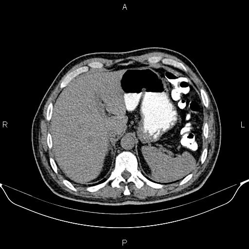 Cecal adenocarcinoma (Radiopaedia 85324-100916 Axial non-contrast 18).jpg