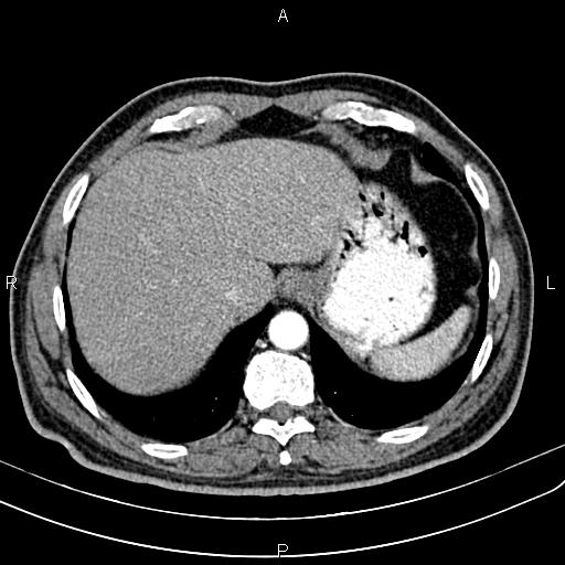 File:Cecal cancer with appendiceal mucocele (Radiopaedia 91080-108651 A 56).jpg