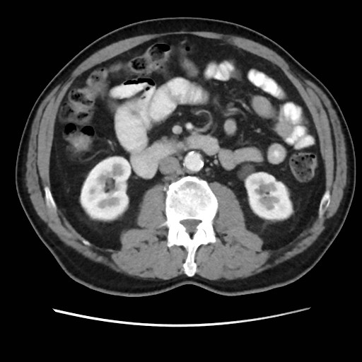 Cecal mass causing appendicitis (Radiopaedia 59207-66531 A 41).jpg