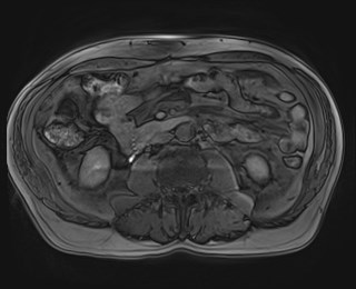 Cecal mass causing appendicitis (Radiopaedia 59207-66532 K 72).jpg