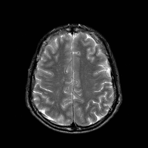 File:Central-variant posterior reversible encephalopathy syndrome (PRES) (Radiopaedia 43880-47358 Axial T2 18).jpg