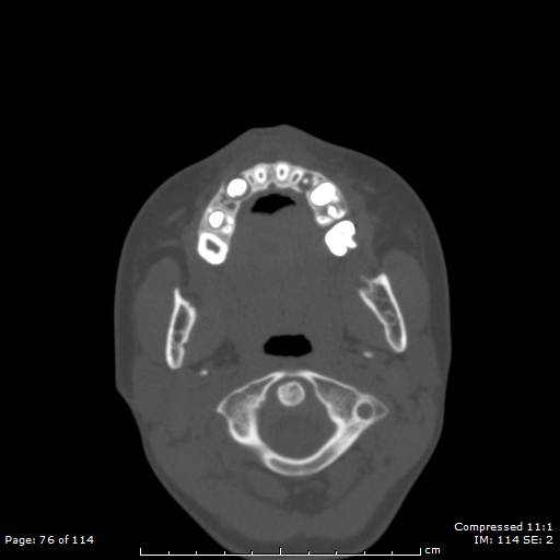 File:Central giant cell granuloma (Radiopaedia 45612-49754 Axial bone window 38).jpg