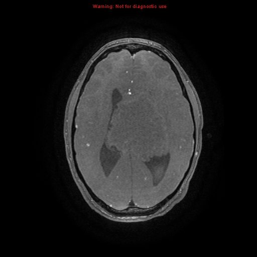 Central neurocytoma (Radiopaedia 13188-13206 Axial MRA 15).jpg