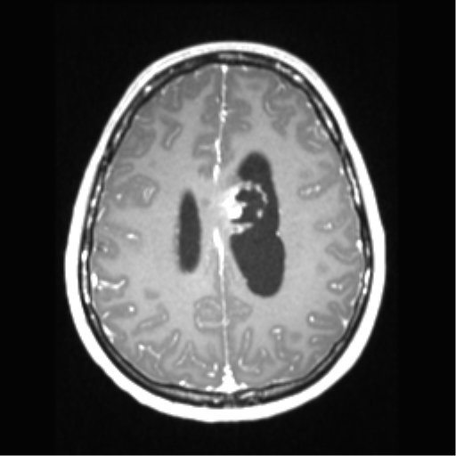 Central neurocytoma (Radiopaedia 37664-39557 Axial T1 C+ 55).png