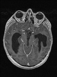 Central neurocytoma (Radiopaedia 56690-63469 Axial T1 C+ 62).jpg