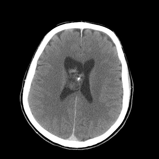 Central neurocytoma (Radiopaedia 68725-78432 Axial C+ 54).jpg