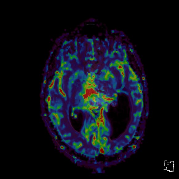 Central neurocytoma (Radiopaedia 84497-99872 Axial Perfusion 172).jpg