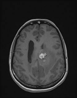 Central neurocytoma (Radiopaedia 84497-99872 Axial T1 134).jpg
