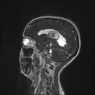 File:Central neurocytoma (Radiopaedia 84497-99872 Sagittal CISS 15).jpg