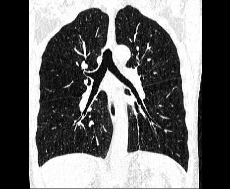 Centrilobular pulmonary emphysema (Radiopaedia 62468-70718 Coronal lung window 42).jpg