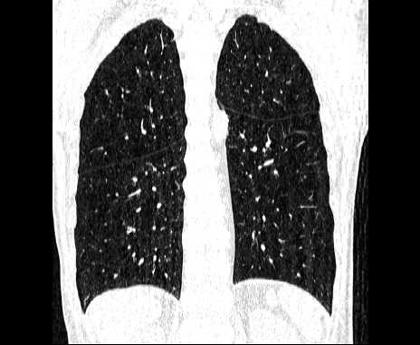 Centrilobular pulmonary emphysema (Radiopaedia 62468-70718 Coronal lung window 53).jpg