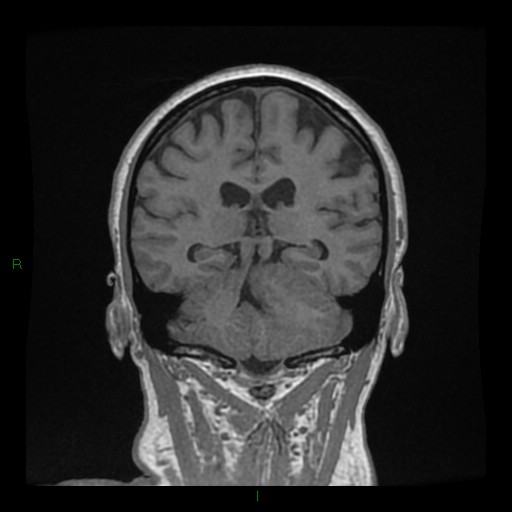 Cerebellar abscess (Radiopaedia 78135-90678 Coronal T1 C+ 102).jpg
