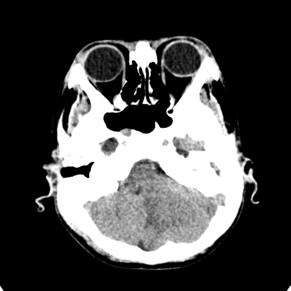 Cerebellar abscess secondary to mastoiditis (Radiopaedia 26284-26412 Axial non-contrast 30).jpg