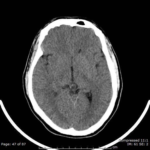 Cerebellar hemangioblastoma (Radiopaedia 52360-58258 Axial non-contrast 47).jpg