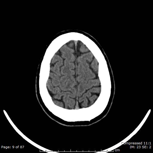 Cerebellar hemangioblastoma (Radiopaedia 52360-58258 Axial non-contrast 9).jpg