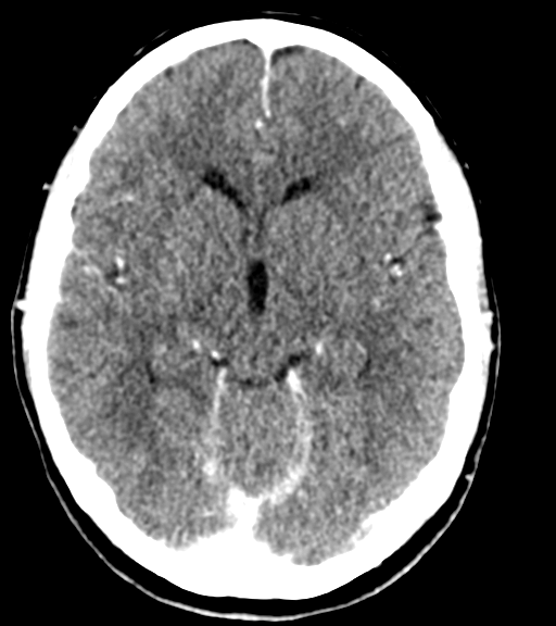 File:Cerebellar metastases - colorectal adenocarcinoma (Radiopaedia 40947-43652 Axial C+ 25).png