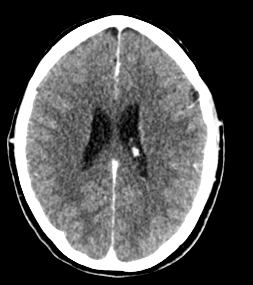 Cerebellar metastases - colorectal adenocarcinoma (Radiopaedia 40947-43652 Axial C+ 38).png