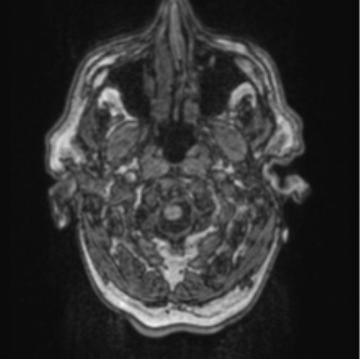 Cerebellar metastasis from lung adenocarcinoma (Radiopaedia 86690-102829 Axial T1 8).png