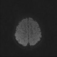 File:Cerebellar stroke (Radiopaedia 32202-33150 Axial DWI 41).png