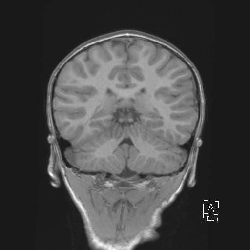 File:Cerebellar stroke (Radiopaedia 32202-33150 Coronal T1 39).png