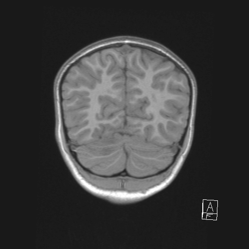 File:Cerebellar stroke (Radiopaedia 32202-33150 Coronal T1 49).png