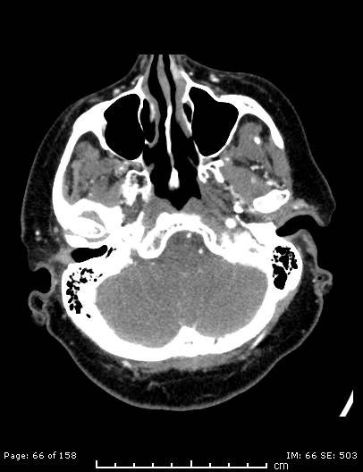 Cerebellar strokes due to intracranial giant cell arteritis (Radiopaedia 68799-78510 CT angiogram 66).jpg