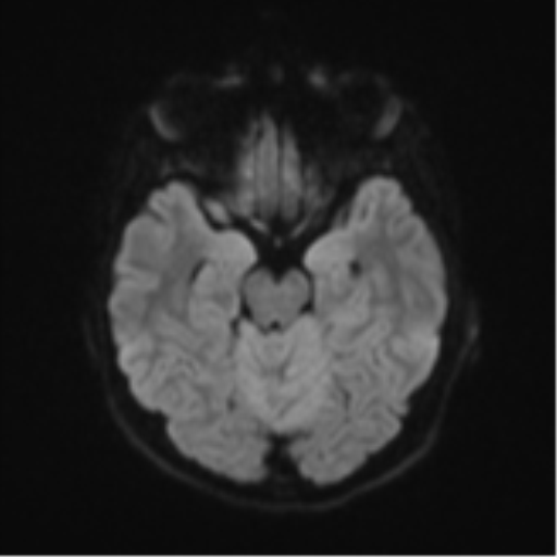 Cerebellar tuberculomas (Radiopaedia 46939-51472 Axial DWI 39).png