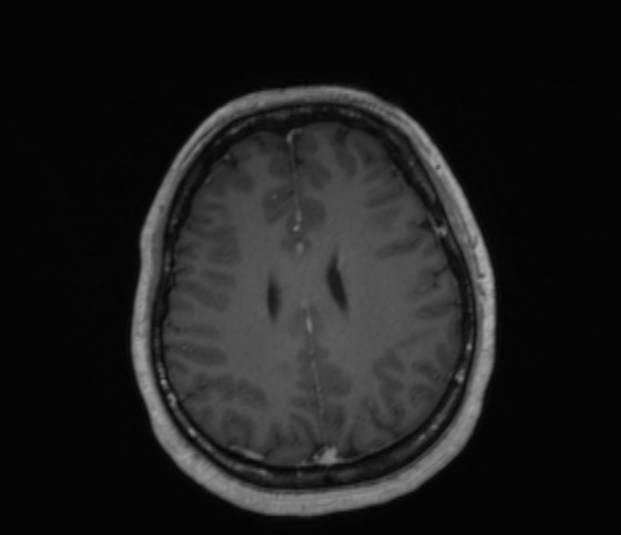 Cerebellopontine angle meningioma (Radiopaedia 35181-36715 Axial T1 C+ 20).jpg