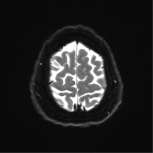 Cerebellopontine angle meningioma (Radiopaedia 48434-53348 Axial DWI 35).png