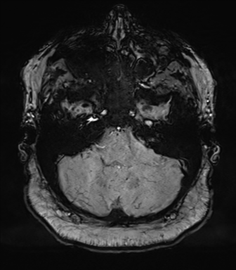 File:Cerebellopontine angle meningioma (Radiopaedia 48434-53348 Axial SWI 20).png