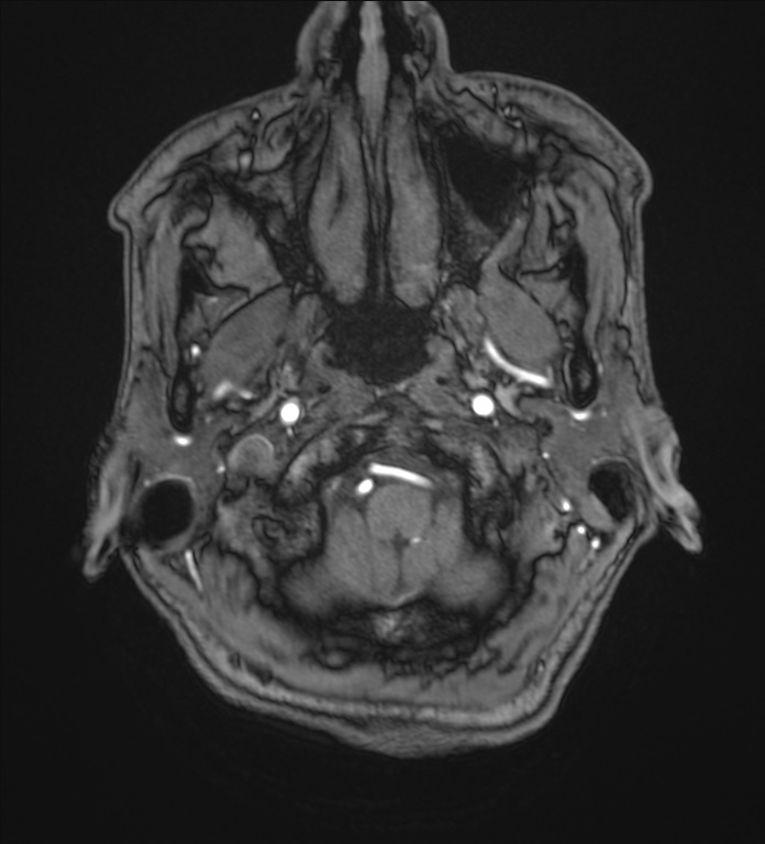 Cerebellopontine angle meningioma (Radiopaedia 72983-83680 Axial MRA 2).jpg