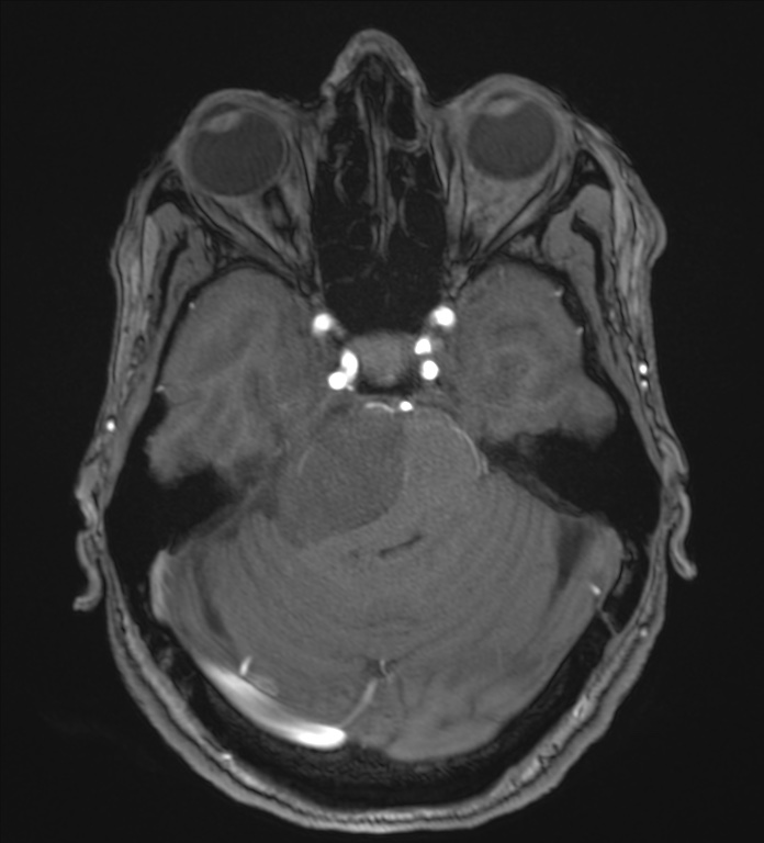 Cerebellopontine angle meningioma (Radiopaedia 72983-83680 Axial MRA 36).jpg