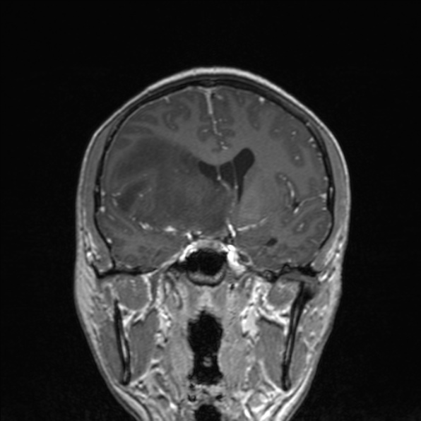 File:Cerebral abscess (Radiopaedia 24212-24478 Coronal T1 C+ 98).jpg