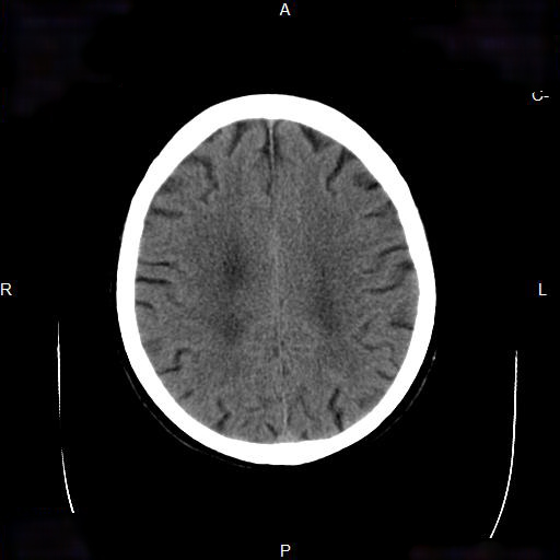 File:Cerebral abscess (Radiopaedia 7606-8431 Axial non-contrast 19).jpg