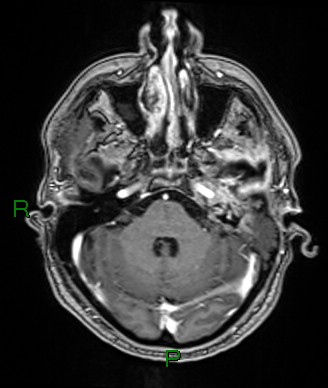Cerebral abscess and subdural empyema (Radiopaedia 84436-99779 Axial T1 C+ 65).jpg