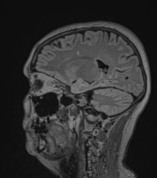 Cerebral abscess from pulmonary arteriovenous malformation (Radiopaedia 86275-102291 Sagittal FLAIR 28).png
