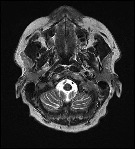 File:Cerebral abscess with ventriculitis (Radiopaedia 78965-91878 Axial T2 5).jpg
