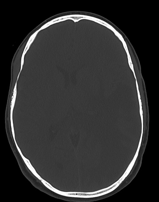 Cerebral abscesses (Radiopaedia 70458-80568 Axial bone window 34).jpg