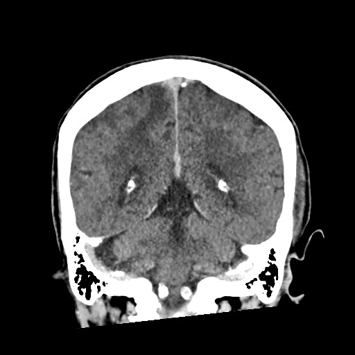 Cerebral amyloid angiopathy-related inflammation (Radiopaedia 74836-85848 Coronal non-contrast 48).jpg