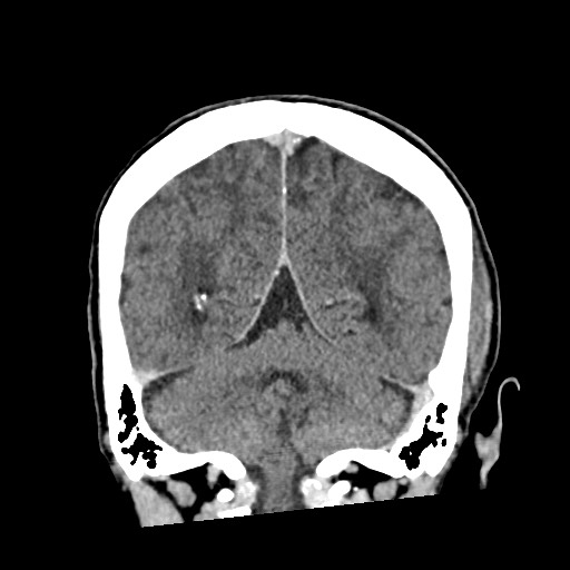 File:Cerebral amyloid angiopathy-related inflammation (Radiopaedia 74836-85848 Coronal non-contrast 51).jpg
