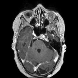 Cerebral amyloid angiopathy (Radiopaedia 29129-29518 Axial T1 C+ 47).jpg