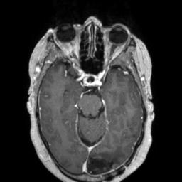 Cerebral amyloid angiopathy (Radiopaedia 29129-29518 Axial T1 C+ 57).jpg