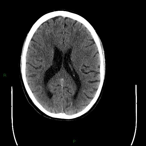 Cerebral amyloid angiopathy (Radiopaedia 77506-89665 Axial non-contrast 63).jpg