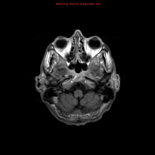 File:Cerebral and orbital tuberculomas (Radiopaedia 13308-13311 Axial T1 C+ 4).jpg