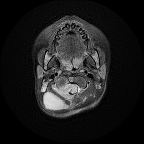 File:Cerebral and spinal tuberculosis (Radiopaedia 90489-107837 Axial FLAIR 1).jpg