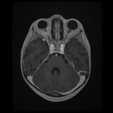 Cerebral and spinal tuberculosis (Radiopaedia 90489-107837 Axial T1 C+ 69).jpg